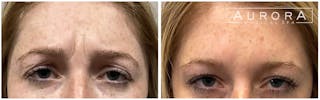 BOTOX Before & After Gallery - Patient 107279 - Image 2