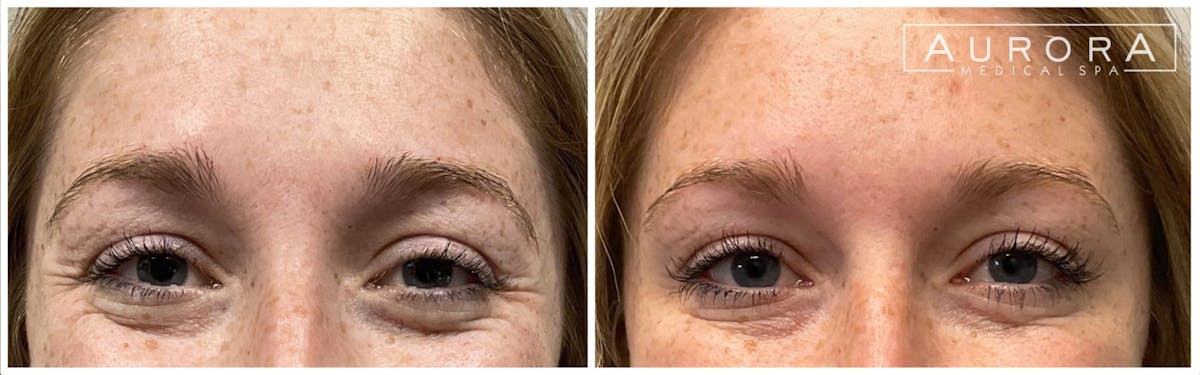 BOTOX Before & After Gallery - Patient 107279 - Image 3
