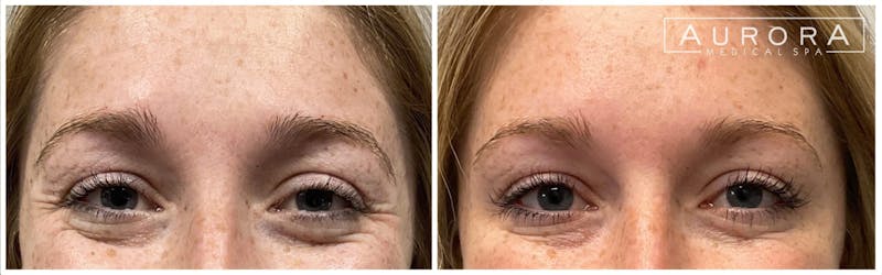 BOTOX Before & After Gallery - Patient 107279 - Image 3