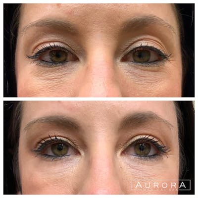 Facial Balancing Before & After Gallery - Patient 257568 - Image 1