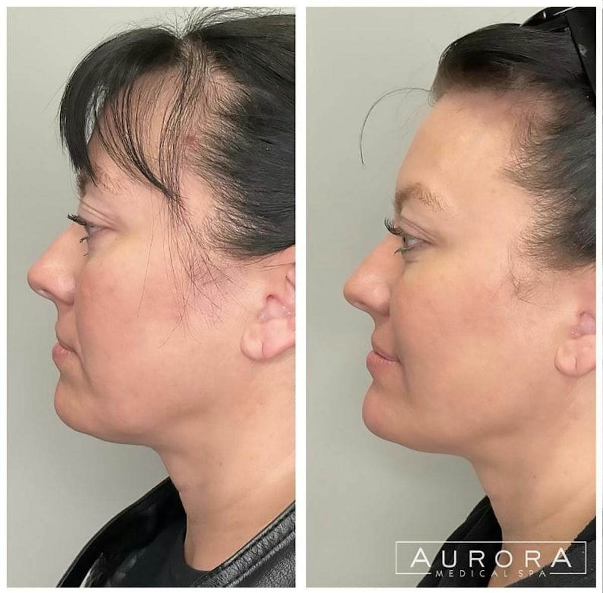 Facial Balancing Before & After Gallery - Patient 369068 - Image 2