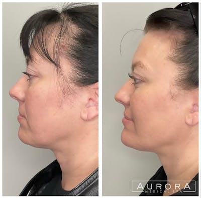 Facial Balancing Before & After Gallery - Patient 369068 - Image 2