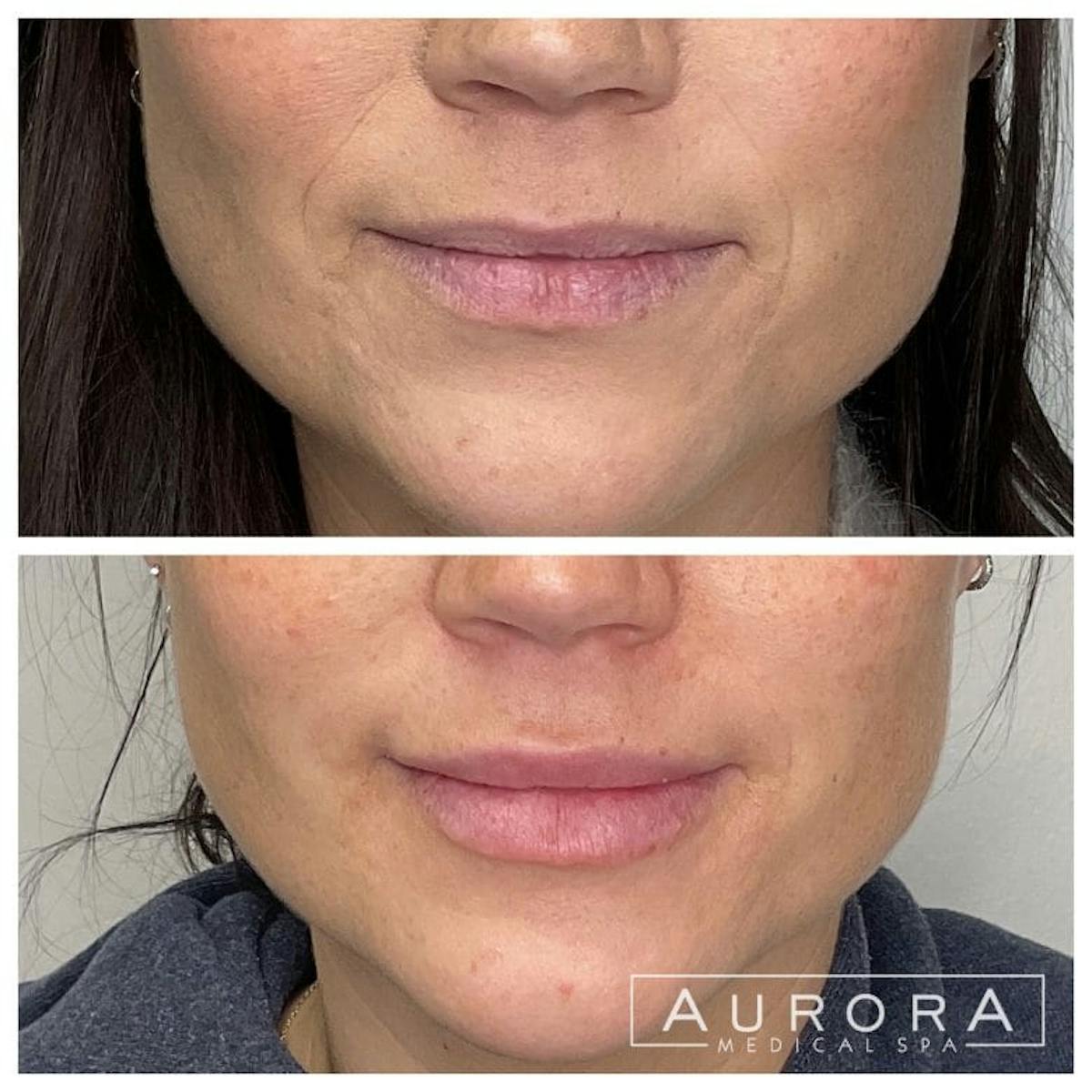 Facial Balancing Before & After Gallery - Patient 181123 - Image 1