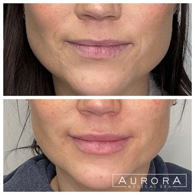 Facial Balancing Before & After Gallery - Patient 181123 - Image 1