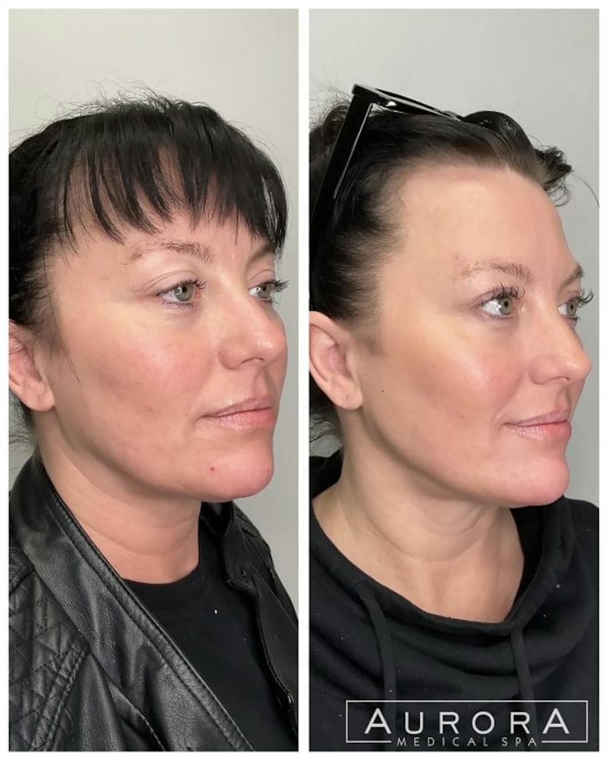 Facial Balancing Before & After Gallery - Patient 369068 - Image 1
