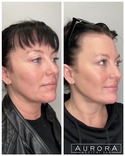 Facial Balancing Before & After Gallery - Patient 369068 - Image 1