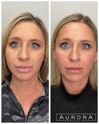 Facial Balancing Before & After Gallery - Patient 543764 - Image 1