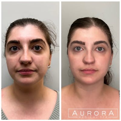 Facial Balancing Before & After Gallery - Patient 232929 - Image 2