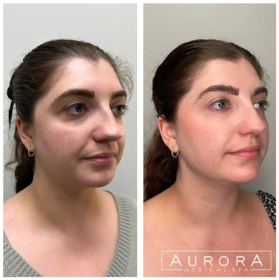 Facial Balancing Before & After Gallery - Patient 232929 - Image 1
