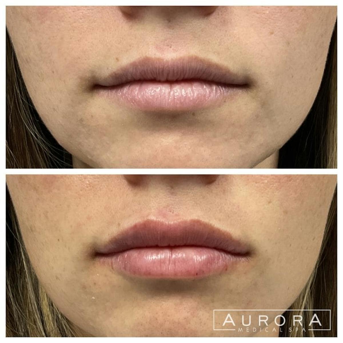 Lip Filler Before & After Gallery - Patient 253132 - Image 1