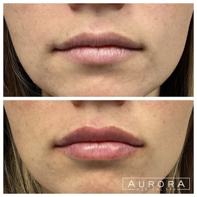 Lip Filler Before & After Gallery - Patient 253132 - Image 1