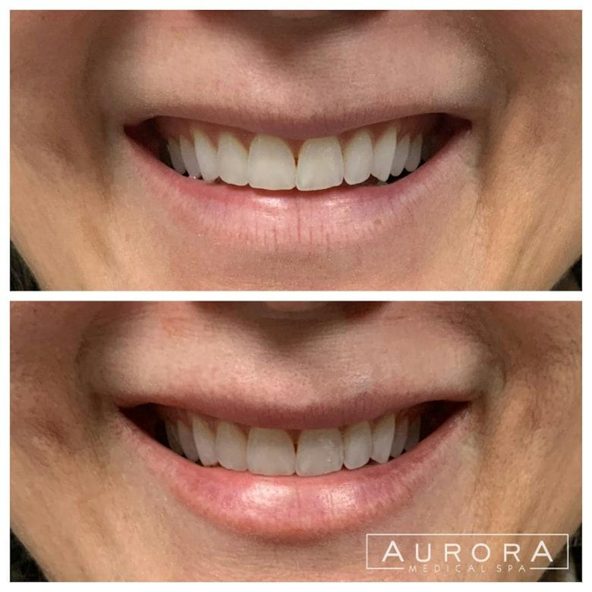 Lip Filler Before & After Gallery - Patient 984926 - Image 1