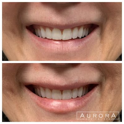 Lip Filler Before & After Gallery - Patient 984926 - Image 1