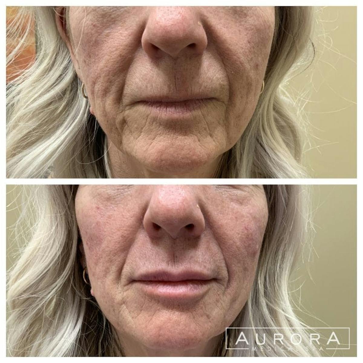 Lip Filler Before & After Gallery - Patient 251937 - Image 2