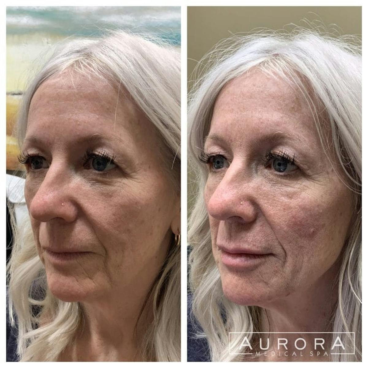 Lip Filler Before & After Gallery - Patient 251937 - Image 1