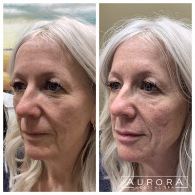 Lip Filler Before & After Gallery - Patient 251937 - Image 1
