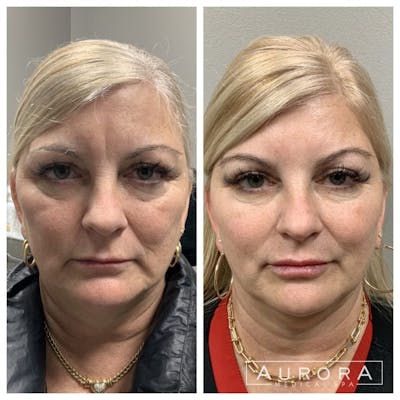 Lip Filler Before & After Gallery - Patient 276398 - Image 1