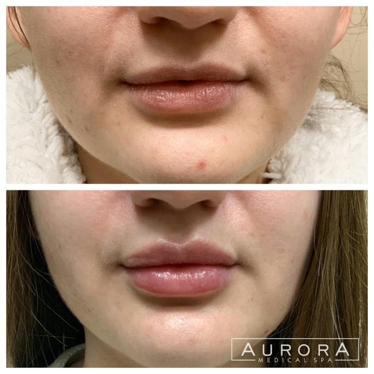 Lip Filler Before & After Gallery - Patient 254036 - Image 1