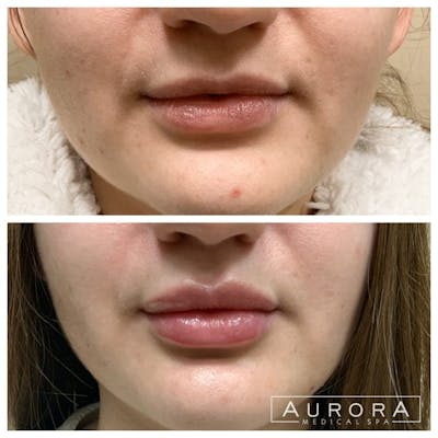 Lip Filler Before & After Gallery - Patient 254036 - Image 1