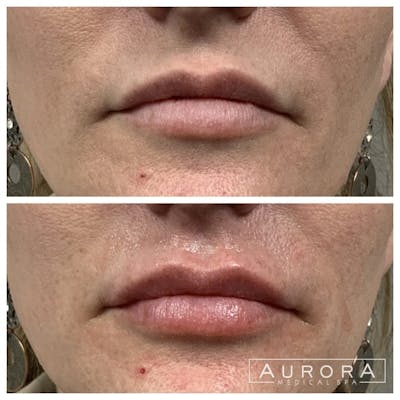 Lip Filler Before & After Gallery - Patient 284899 - Image 1