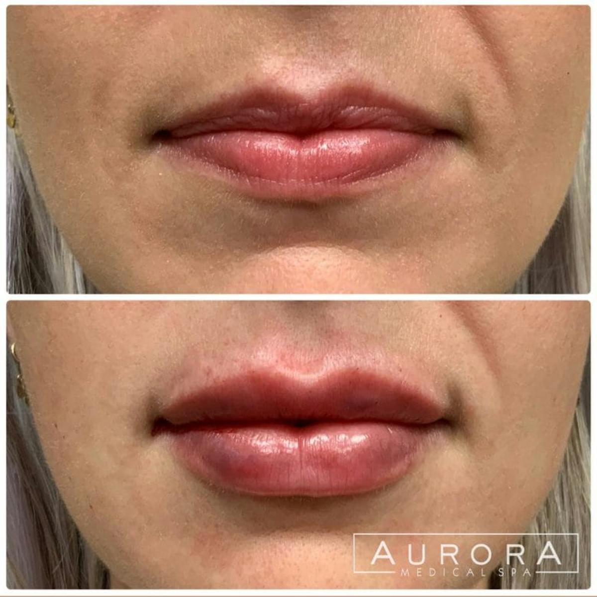 Lip Filler Before & After Gallery - Patient 257930 - Image 1