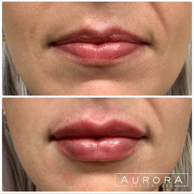 Lip Filler Before & After Gallery - Patient 257930 - Image 1