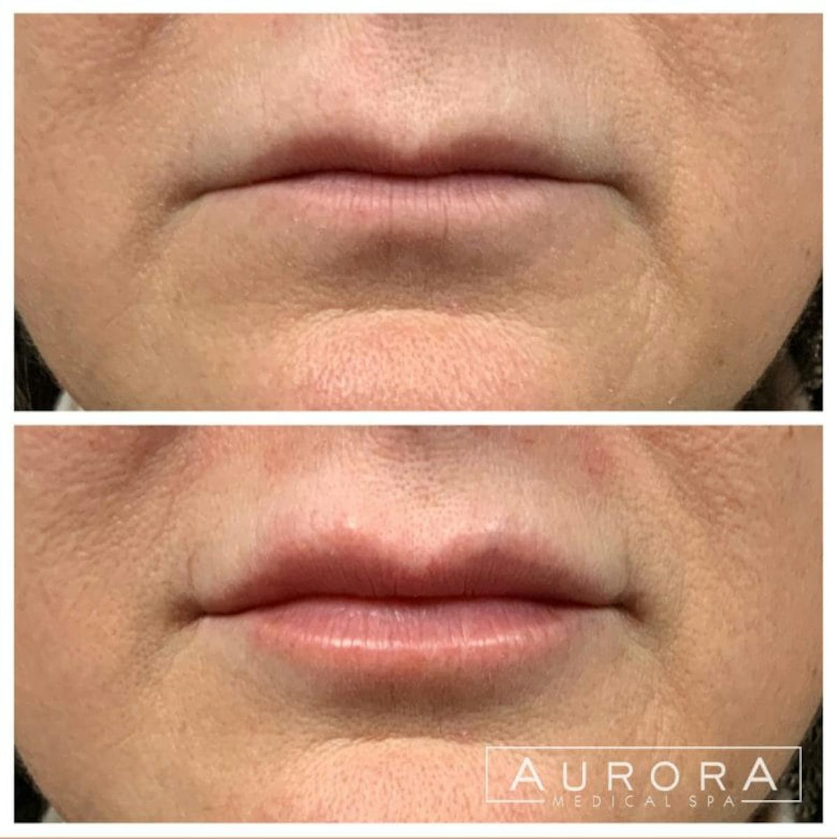 Lip Filler Before & After Gallery - Patient 120544 - Image 1