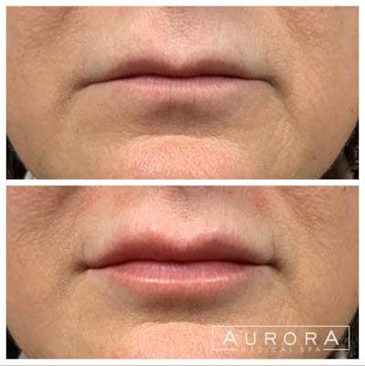 Lip Filler Before & After Gallery - Patient 120544 - Image 1