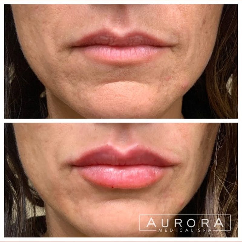 Lip Filler Before & After Gallery - Patient 401414 - Image 1