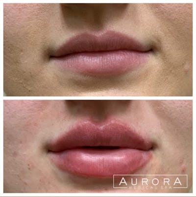 Lip Filler Before & After Gallery - Patient 103636 - Image 1