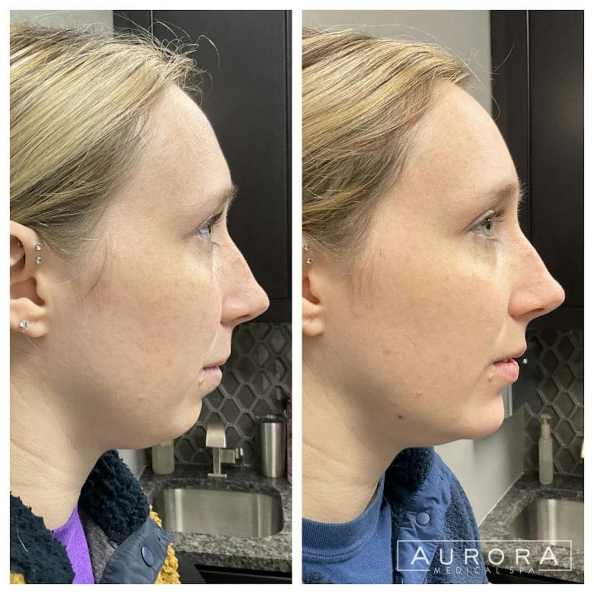 Lip Filler Before & After Gallery - Patient 100332 - Image 2