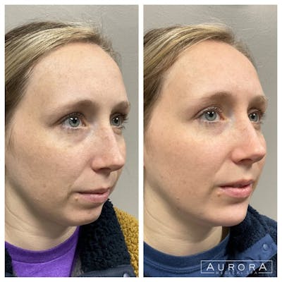Lip Filler Before & After Gallery - Patient 100332 - Image 1