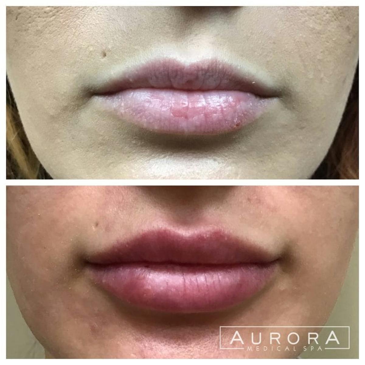 Lip Filler Before & After Gallery - Patient 579731 - Image 1