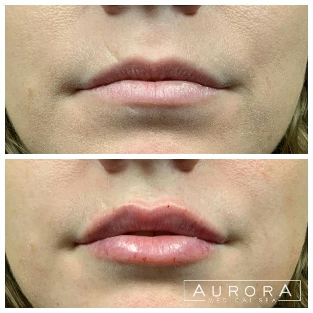 Lip Filler Before & After Gallery - Patient 345675 - Image 1