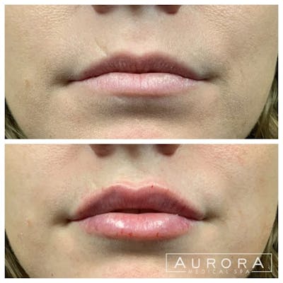Lip Filler Before & After Gallery - Patient 345675 - Image 1