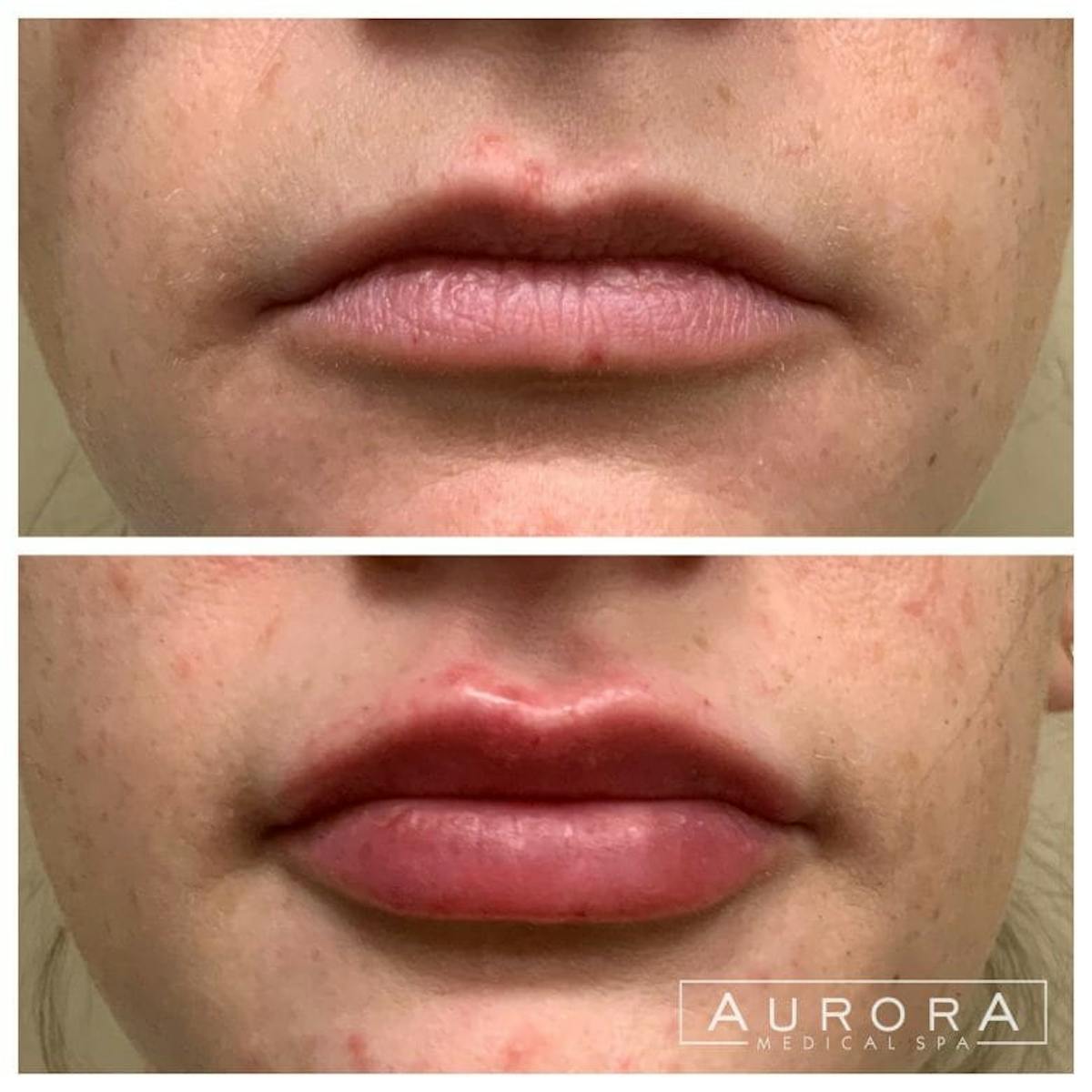 Lip Filler Before & After Gallery - Patient 165236 - Image 2