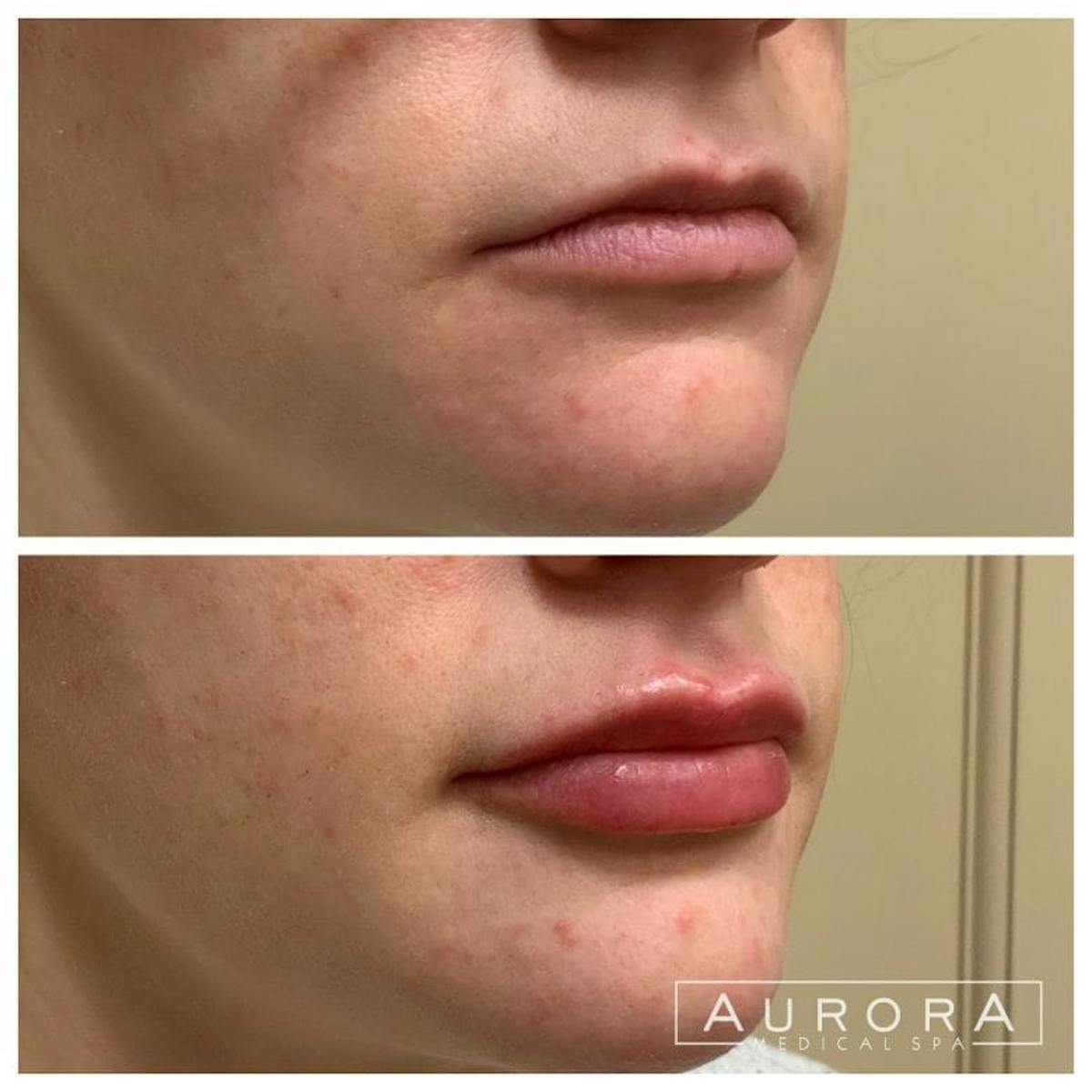 Lip Filler Before & After Gallery - Patient 165236 - Image 1