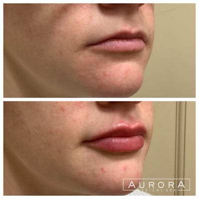 Lip Filler Before & After Gallery - Patient 165236 - Image 1