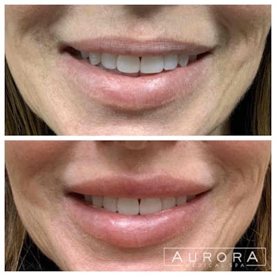 Lip Filler Before & After Gallery - Patient 946247 - Image 1