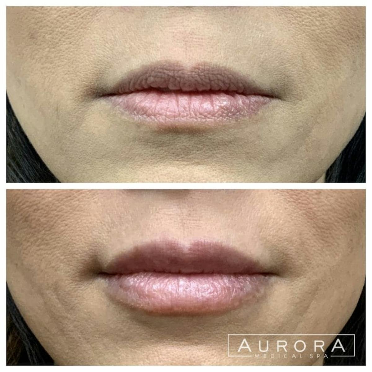 Lip Filler Before & After Gallery - Patient 186951 - Image 1