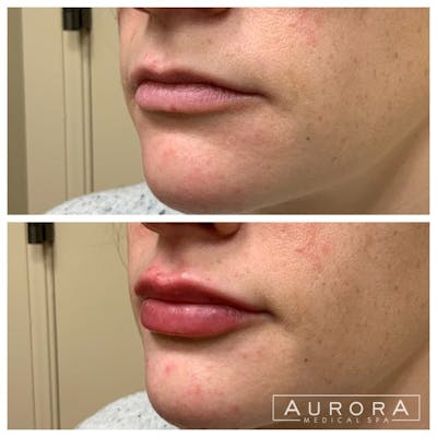 Lip Filler Before & After Gallery - Patient 154652 - Image 1