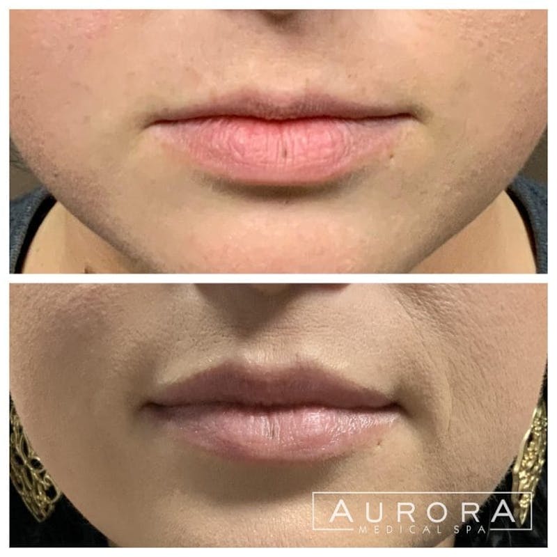 Lip Filler Before & After Gallery - Patient 375782 - Image 1