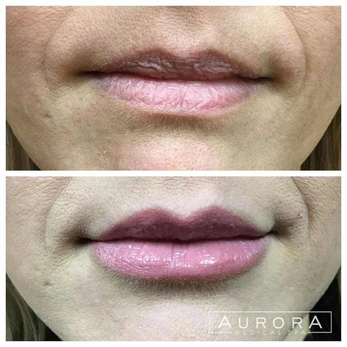 Lip Filler Before & After Gallery - Patient 120859 - Image 1