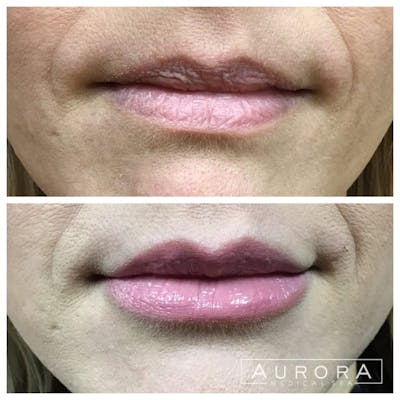 Lip Filler Before & After Gallery - Patient 120859 - Image 1
