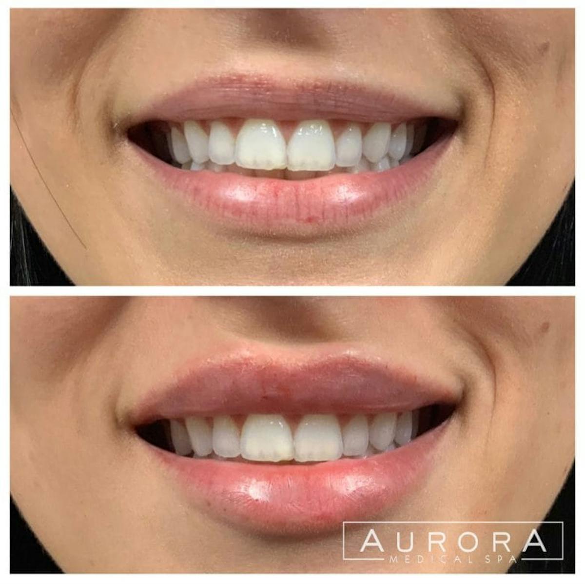 Lip Filler Before & After Gallery - Patient 838413 - Image 2