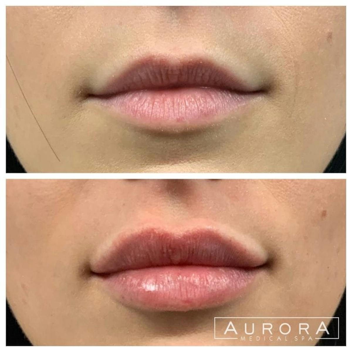 Lip Filler Before & After Gallery - Patient 838413 - Image 1
