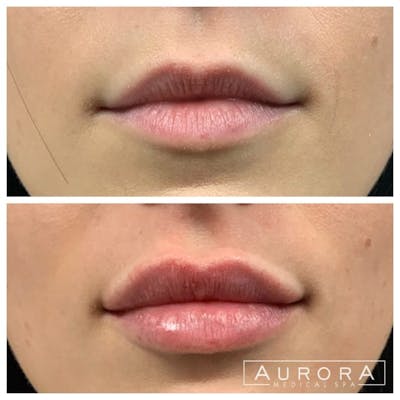 Lip Filler Before & After Gallery - Patient 838413 - Image 1