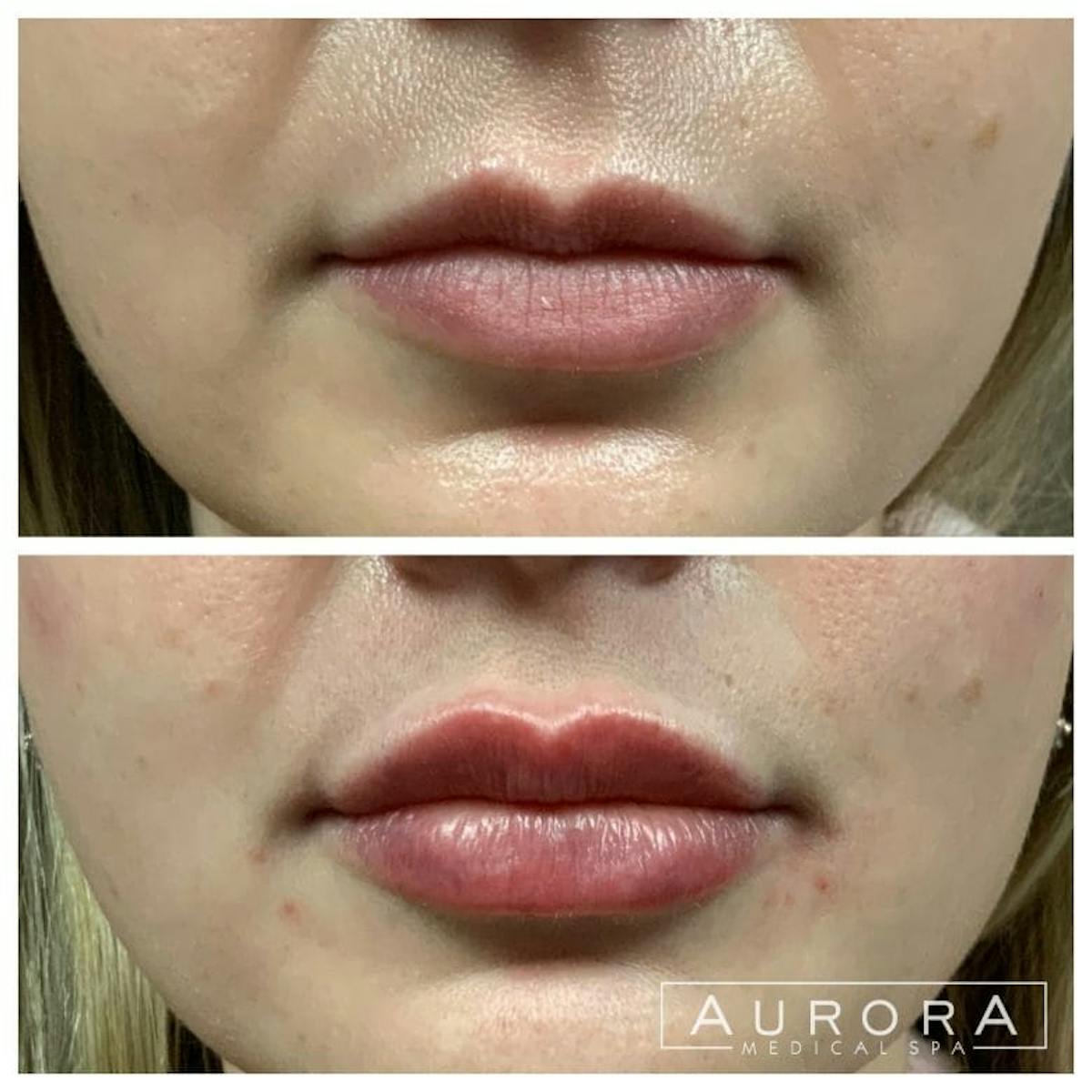 Lip Filler Before & After Gallery - Patient 235572 - Image 2