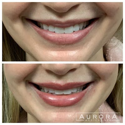 Lip Filler Before & After Gallery - Patient 235572 - Image 1
