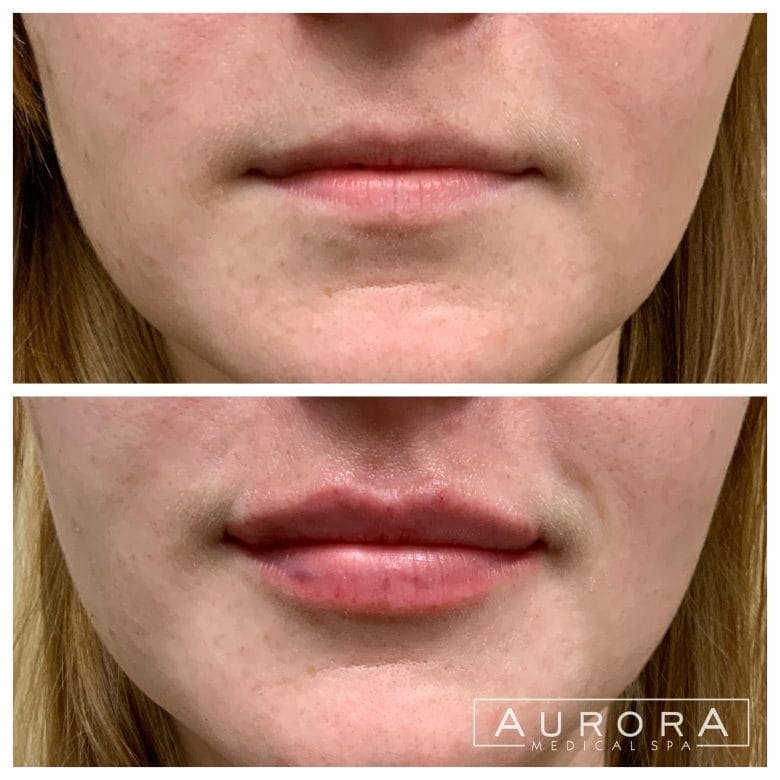 lip filler procedure